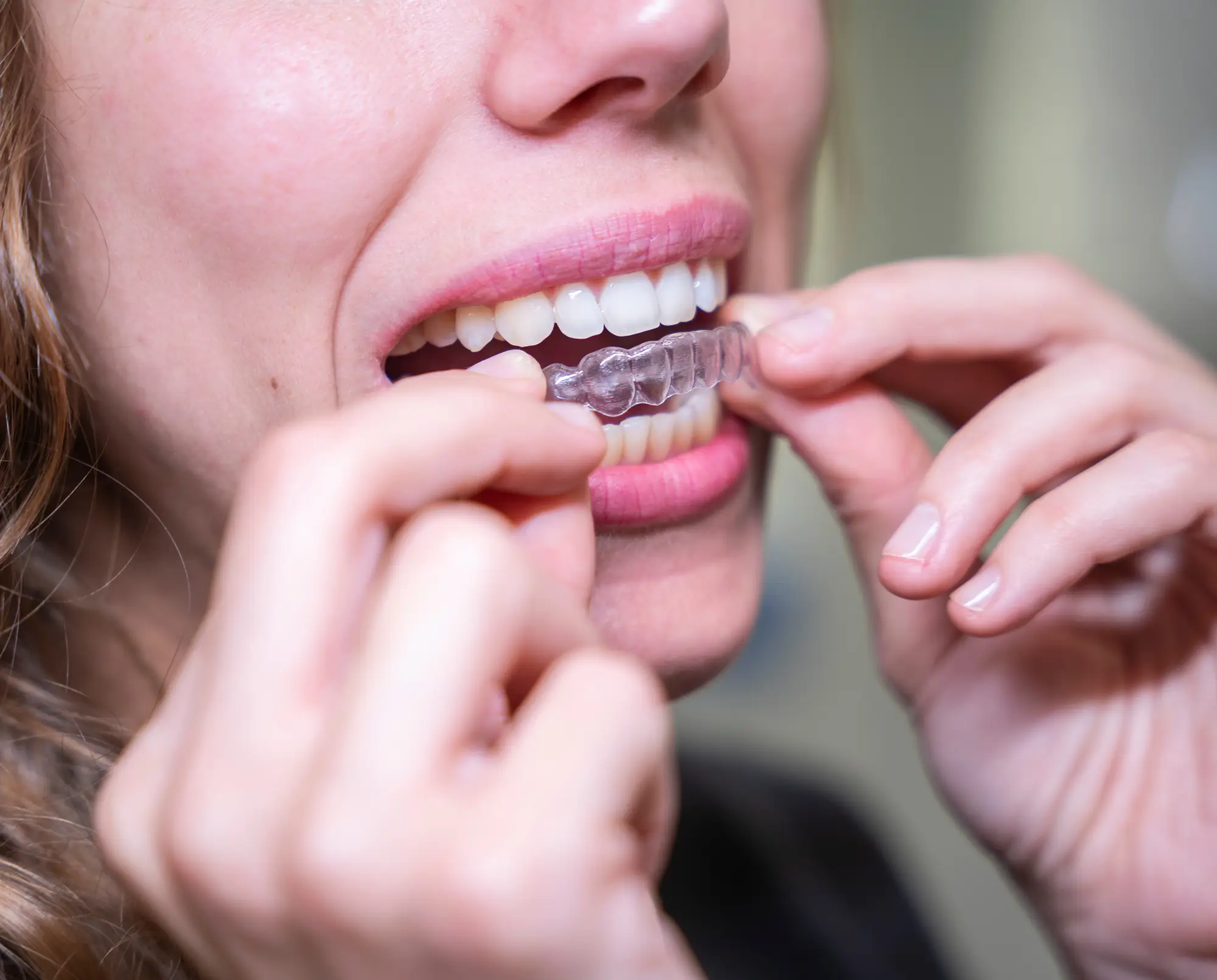 O que é invisalign?