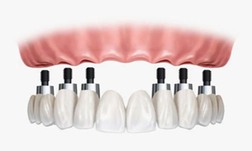 implantes11