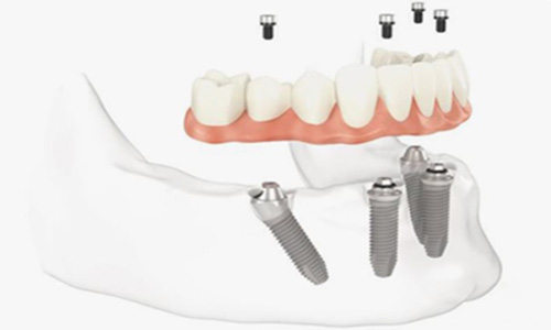 implantes23