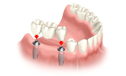 implantes3
