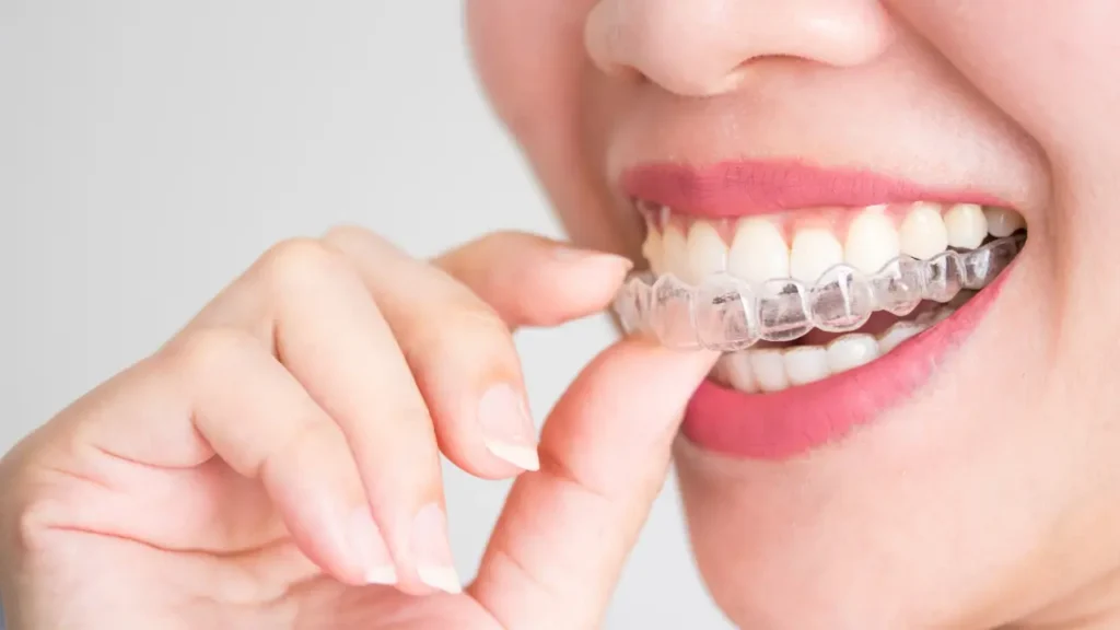 uma mulher colocando um aparelho invisalign